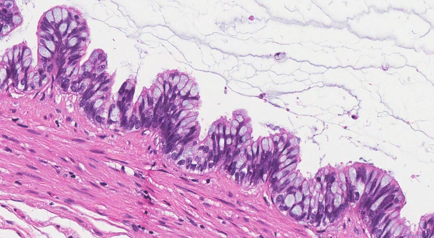 icd 10 code for low grade mucinous neoplasm of appendix