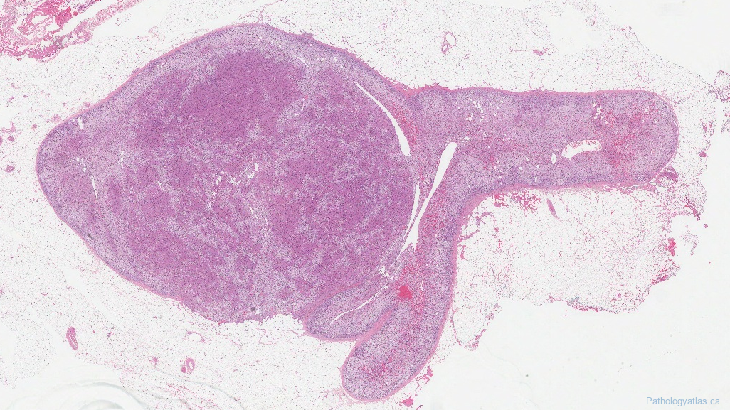 icd 10 adenoma adrenal gland
