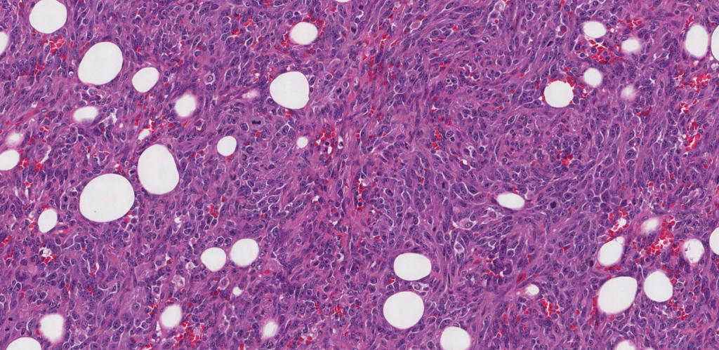 icd 10 code for angiosarcoma of breast