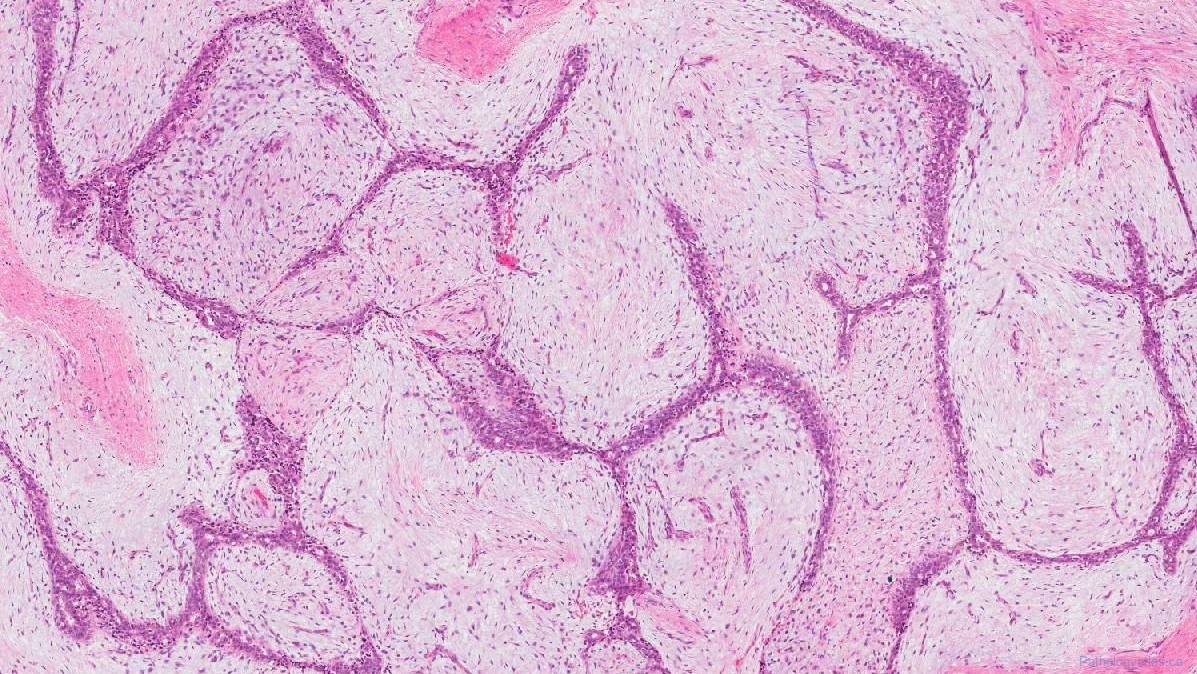 Juvenile Fibroadenoma – Giant juvenile fibroadenoma: A case report – OKZAA