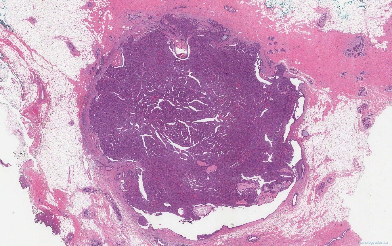 breast intraductal papilloma icd 9
