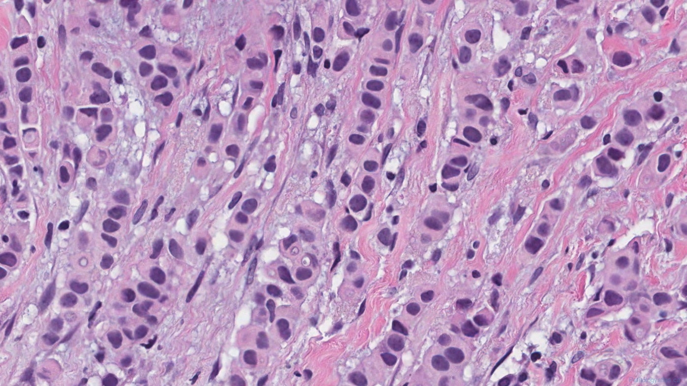 icd 10 code for right breast invasive lobular carcinoma