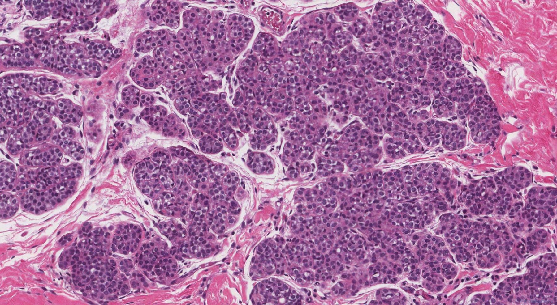 icd 10 code for atypical lobular hyperplasia of breast