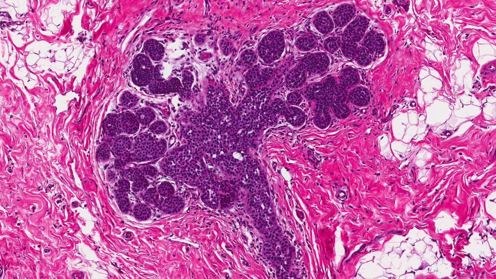 icd 10 code for lobular carcinoma in situ left breast