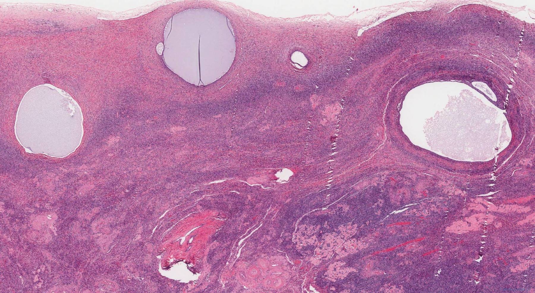 Cortical Inclusion Cysts Of The Ovary Atlas Of Pathology