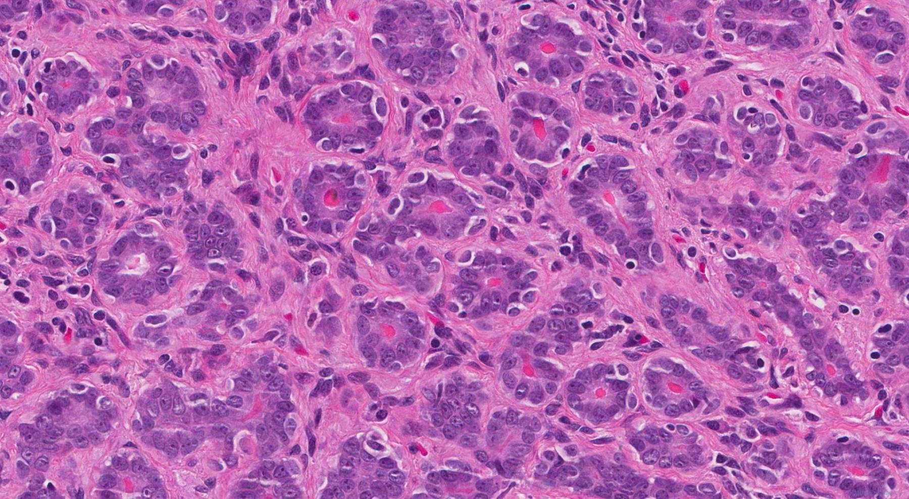 Tubular adenoma of the breast ottawa atlas of pathology