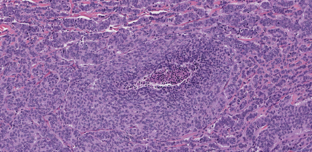 atypical carcinoid lung icd 10
