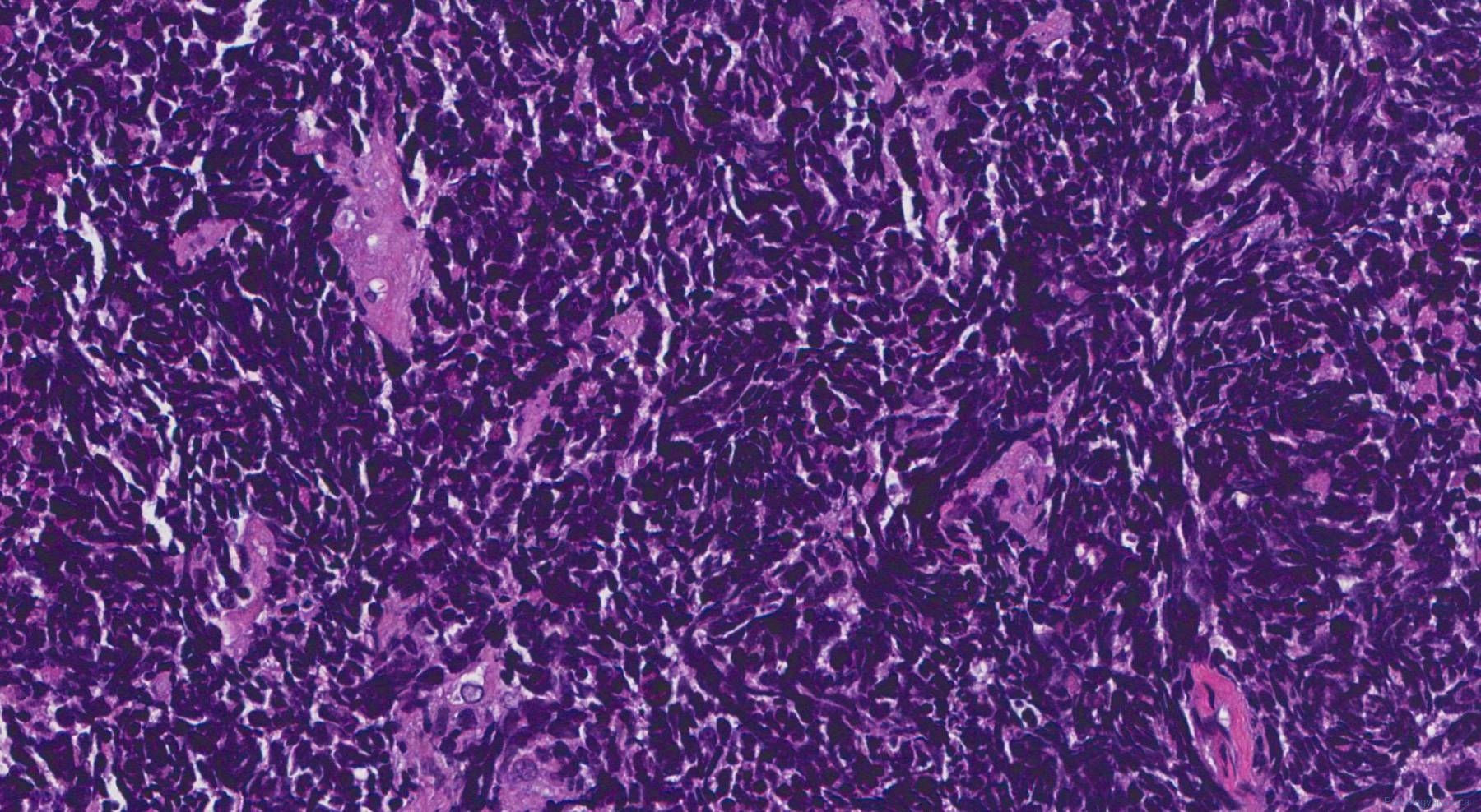 icd 10 code for small cell neuroendocrine carcinoma of lung