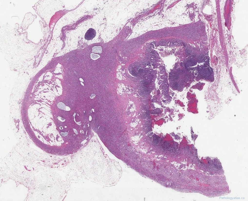 endometriosis appendix icd 10