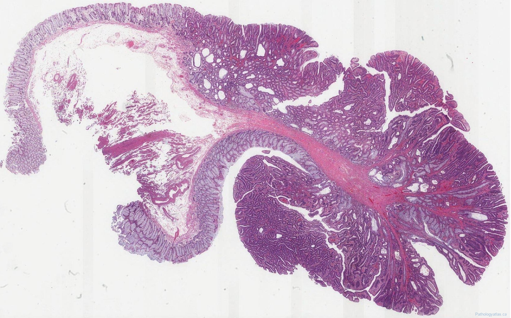 Tubulovillous adenoma of the colon | Ottawa Atlas of Pathology