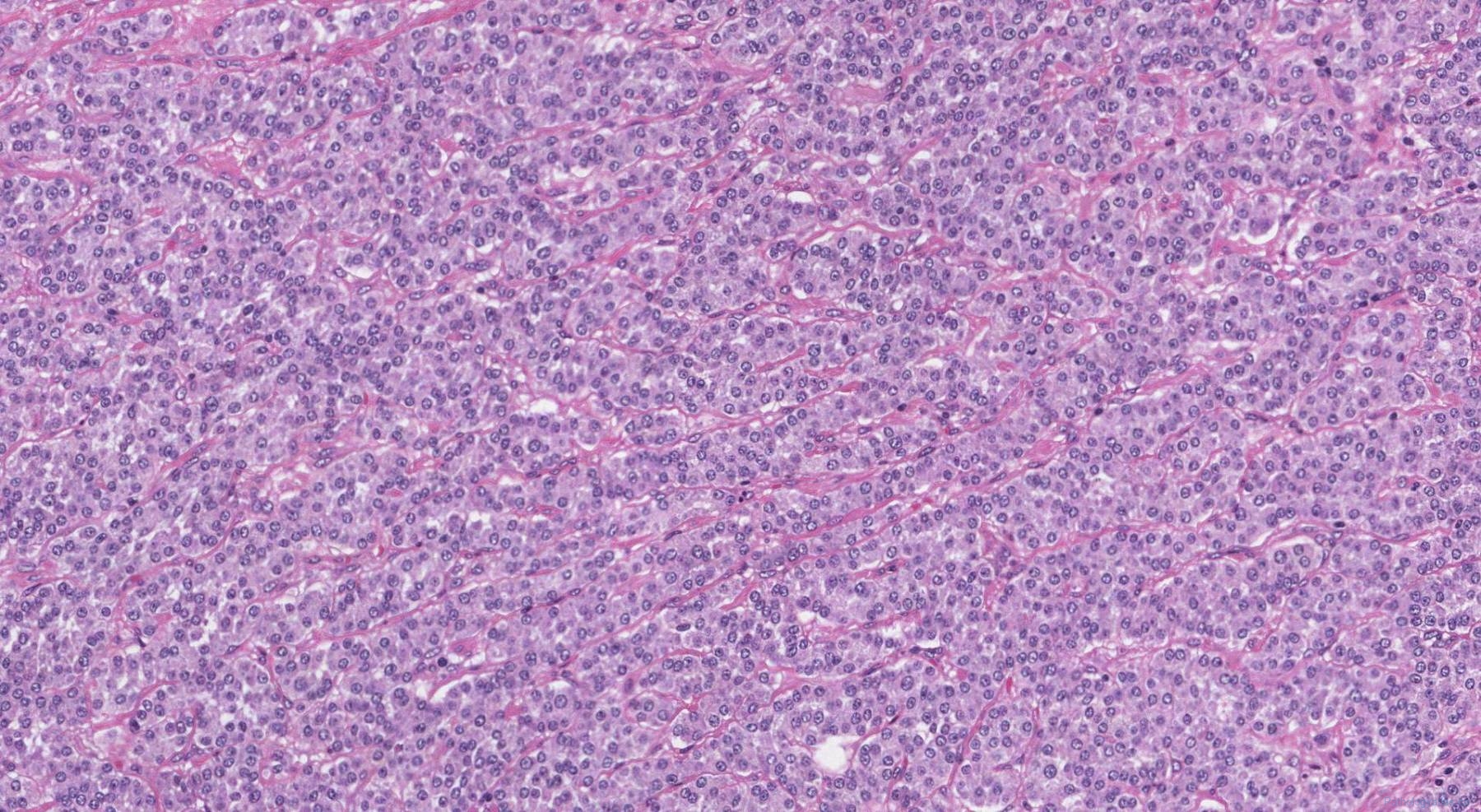 icd 10 code for well differentiated neuroendocrine tumor of stomach